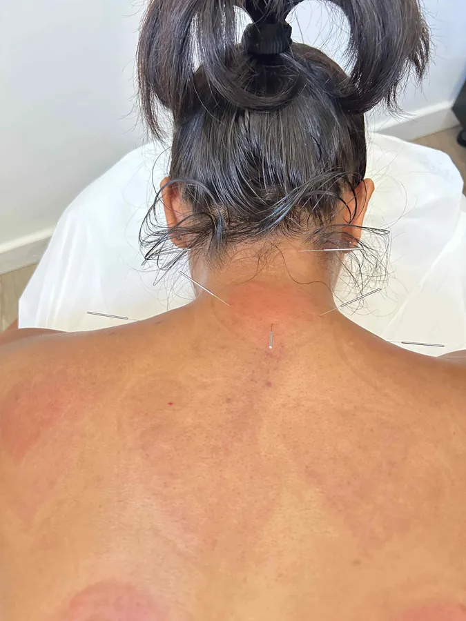 Acupuncture needles placed along the neck and upper back during a treatment